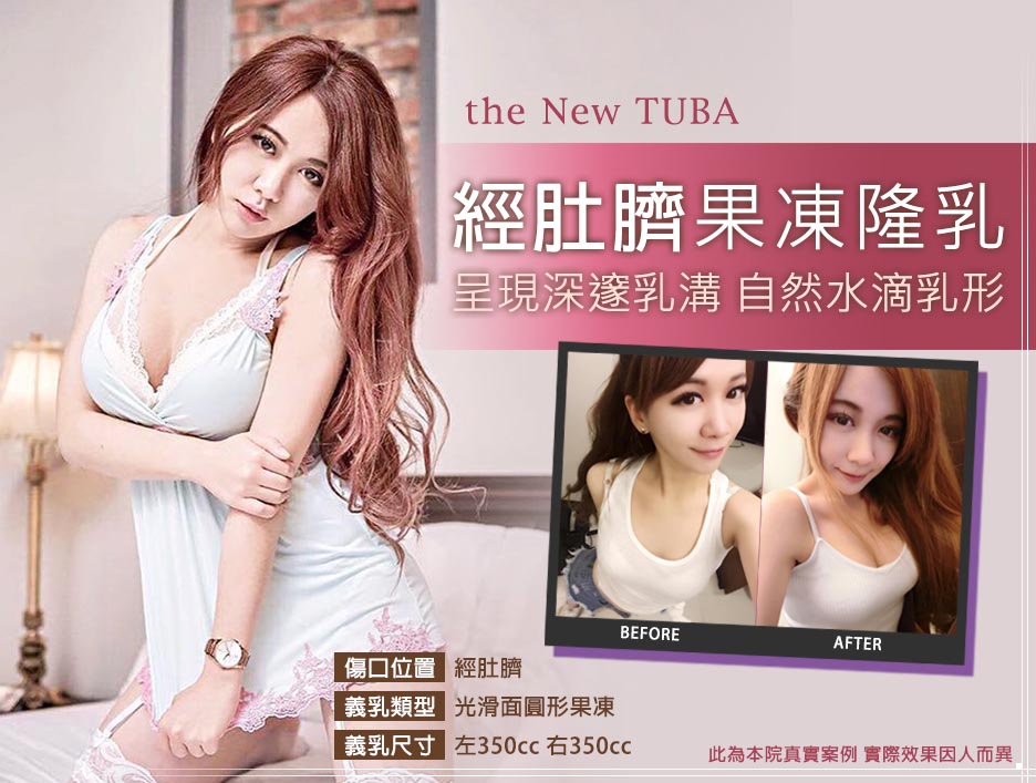 隆乳,隆乳費用,隆乳心得,隆乳手術,隆乳效果,隆乳哺乳,隆乳推薦,水滴型隆乳,果凍隆乳,內視鏡隆乳,經肚臍隆乳,經肚臍隱形隆乳