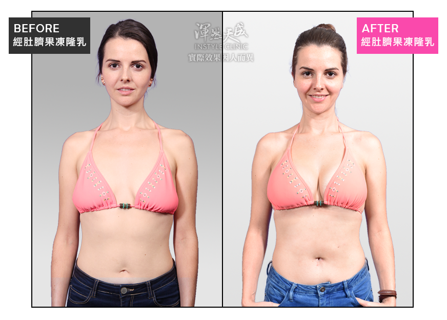 隆乳,隆乳渾然天成,隆乳前後,隆乳效果,隆乳心得,隆乳推薦