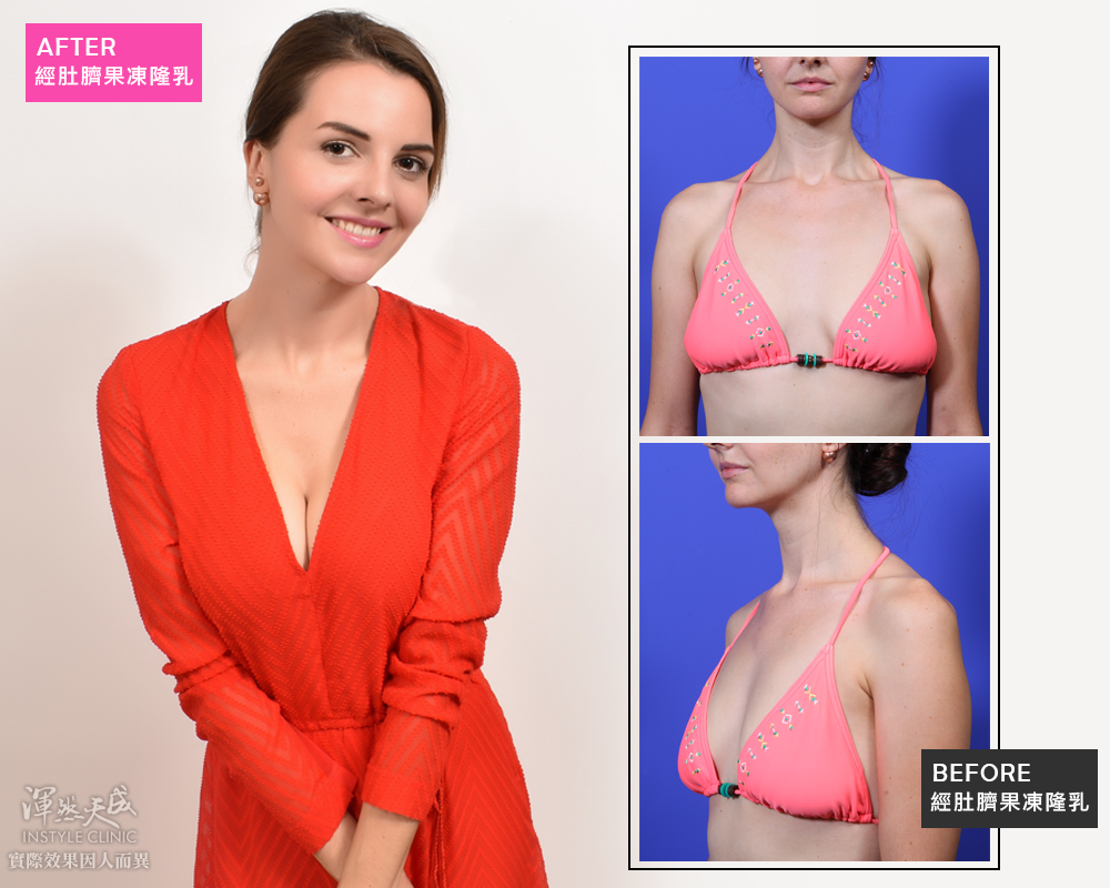 隆乳,隆乳渾然天成,隆乳前後,隆乳效果,隆乳心得,隆乳推薦