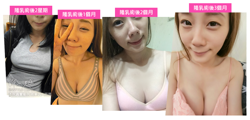 豐胸,隆乳,隆乳實錄,隆乳心得,隆乳效果,豐胸辦法,平胸困擾