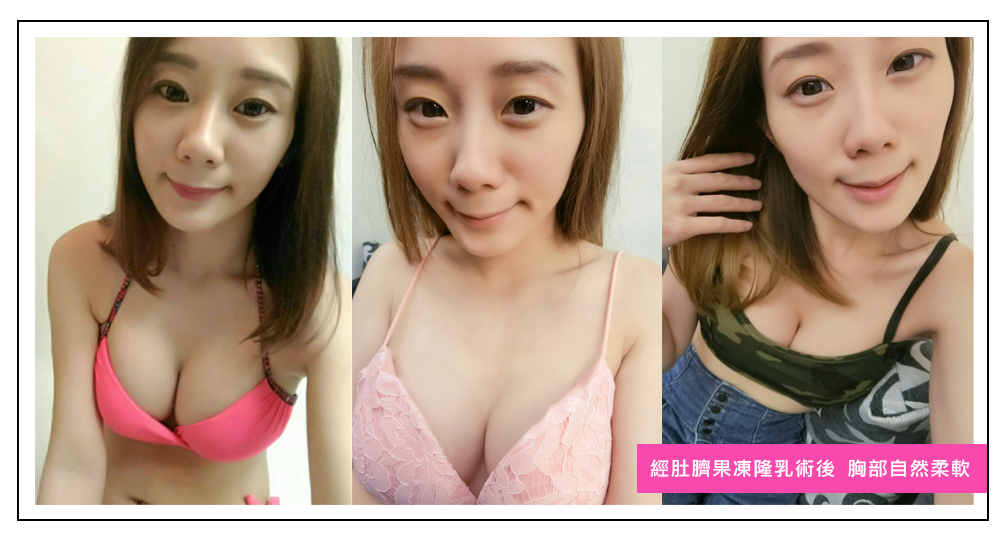 豐胸,隆乳,隆乳實錄,隆乳心得,隆乳效果,豐胸辦法,平胸困擾
