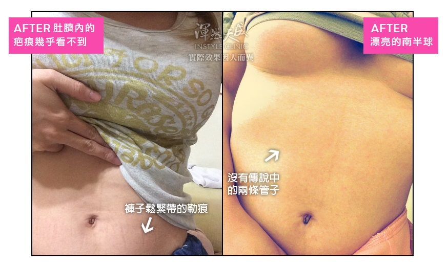 豐胸,隆乳,隆乳實錄,隆乳心得,隆乳效果,豐胸辦法,平胸困擾