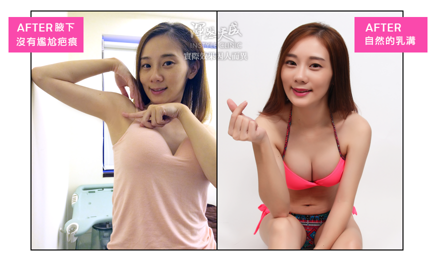 豐胸,隆乳,隆乳實錄,隆乳心得,隆乳效果,豐胸辦法,平胸困擾
