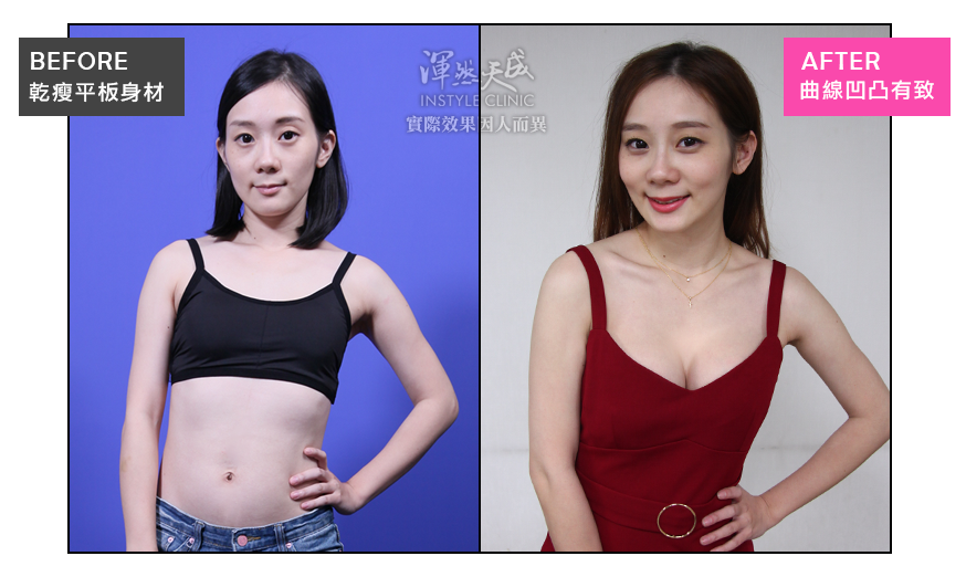 豐胸,隆乳,隆乳實錄,隆乳心得,隆乳效果,豐胸辦法,平胸困擾