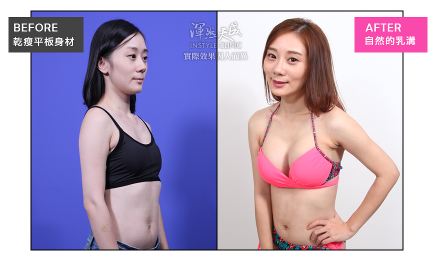 豐胸,隆乳,隆乳實錄,隆乳心得,隆乳效果,豐胸辦法,平胸困擾