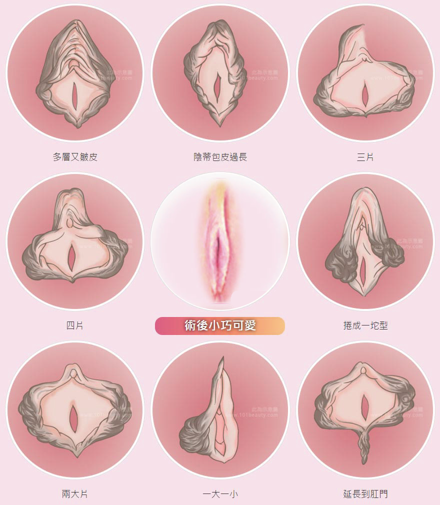小陰唇,私密處,修型,過長,手術,渾然天成,困擾,圖,外翻