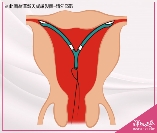 渾然天成整形醫美|移除套管，減掉多餘尼龍線。